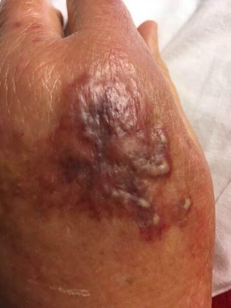 ‘Flesh-eating’ bacteria cases are popping up along the Gulf Coast. What you need to know. – USA Today
